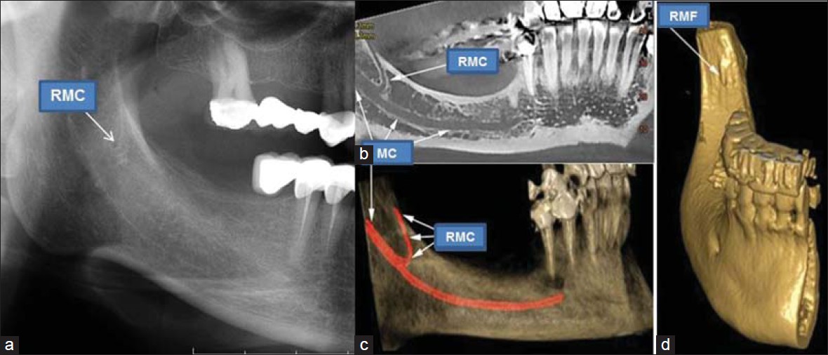 Radiografii mandibula 3D CRANEX3D